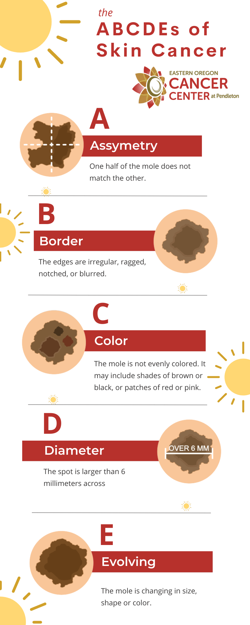 The ABCDEs of Skin Cancer